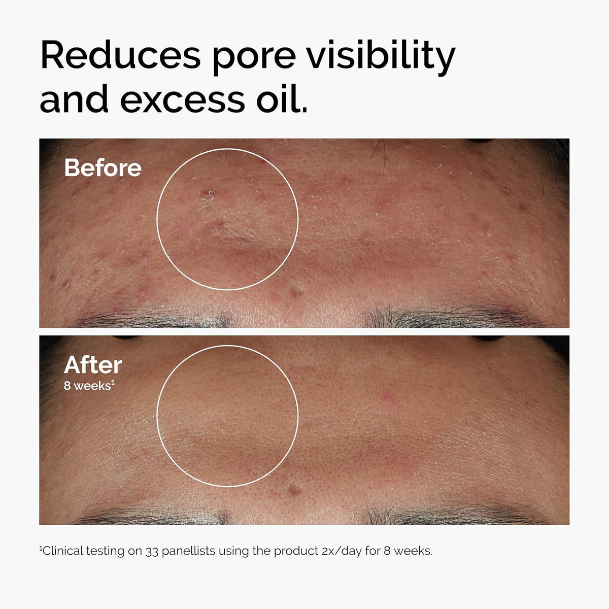 The Ordinary Niacinamide 10% + Zinc 1% – Smoothing Serum for Blemish-Prone Skin