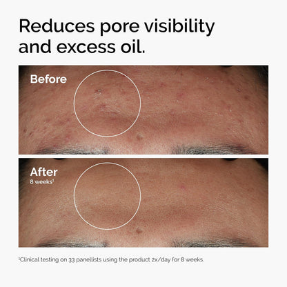 The Ordinary Niacinamide 10% + Zinc 1% – Smoothing Serum for Blemish-Prone Skin